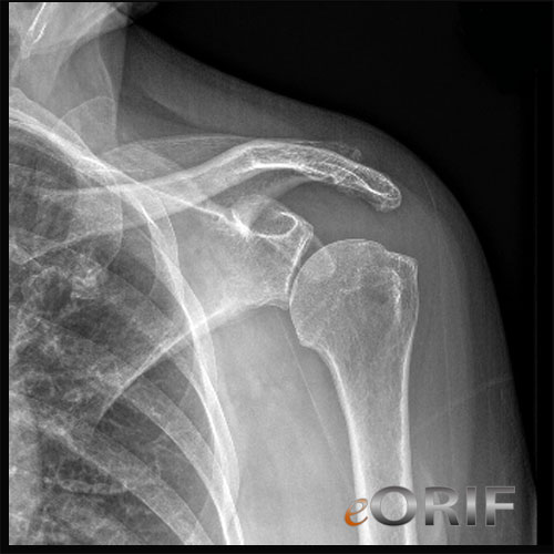 Inferior subluxation of the humeral head S43.083A | eORIF